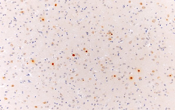 8F1 HD (Case 8) L6 1C2 cortex 1C2 20X