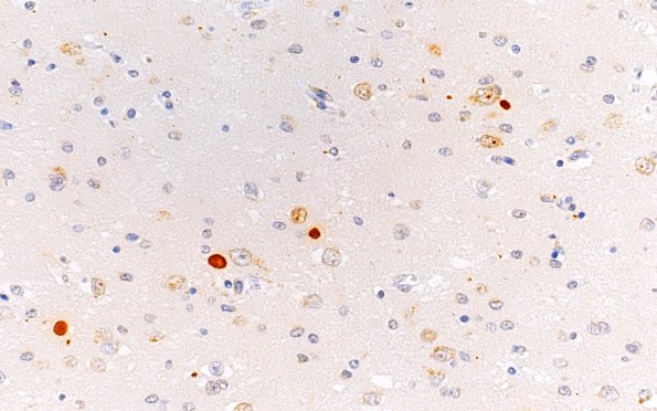 8F2 HD (Case 8) L6 1C2 put 1C2 40X correct