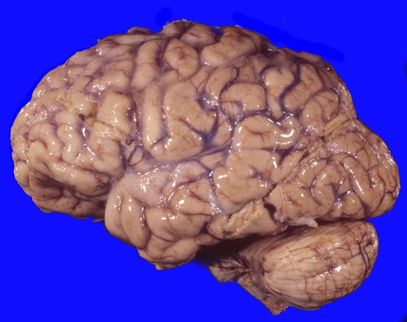 9A1 Huntington Dz (Case 9) 4