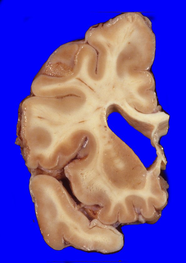 9A2 Huntington Dz (Case 9) 1