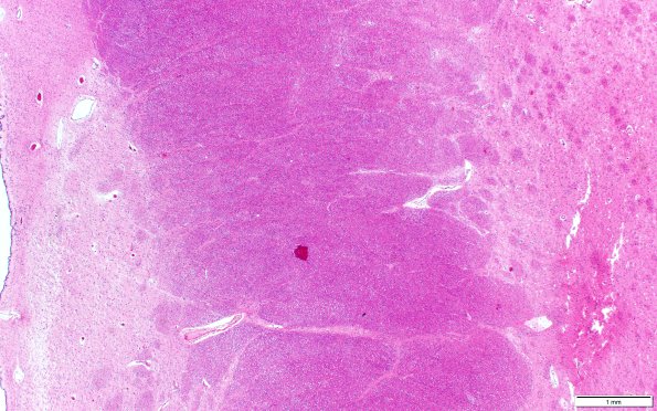 9B2 Huntington Dz (Case 9) N2 H&E 2x scale