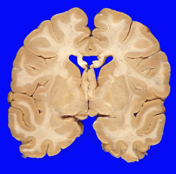 1A1 INAD (Seitelberger Dz, Case 1) 1