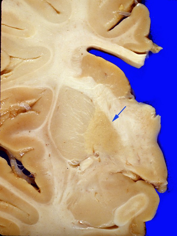 1A3 INAD (Seitelberger Dz, Case 1) 4 copy