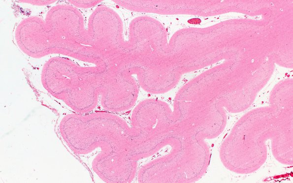 1E1 INAD (Seitelberger Dz, Case 1) Cerebellum F 2X