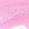 1E2 INAD (Seitelberger Dz, Case 1) Cerebellum F 20X copy