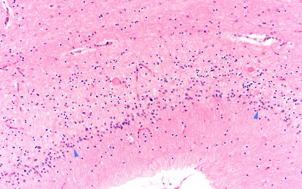 1E2 INAD (Seitelberger Dz, Case 1) Cerebellum F 20X copy