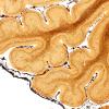 1E4 INAD (Seitelberger Dz, Case 1) Cerebellum F Biels 2X