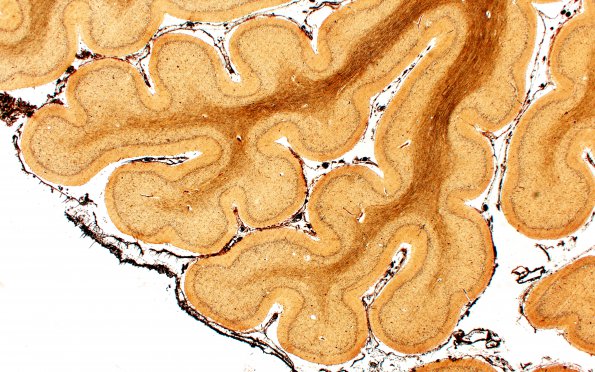 1E4 INAD (Seitelberger Dz, Case 1) Cerebellum F Biels 2X