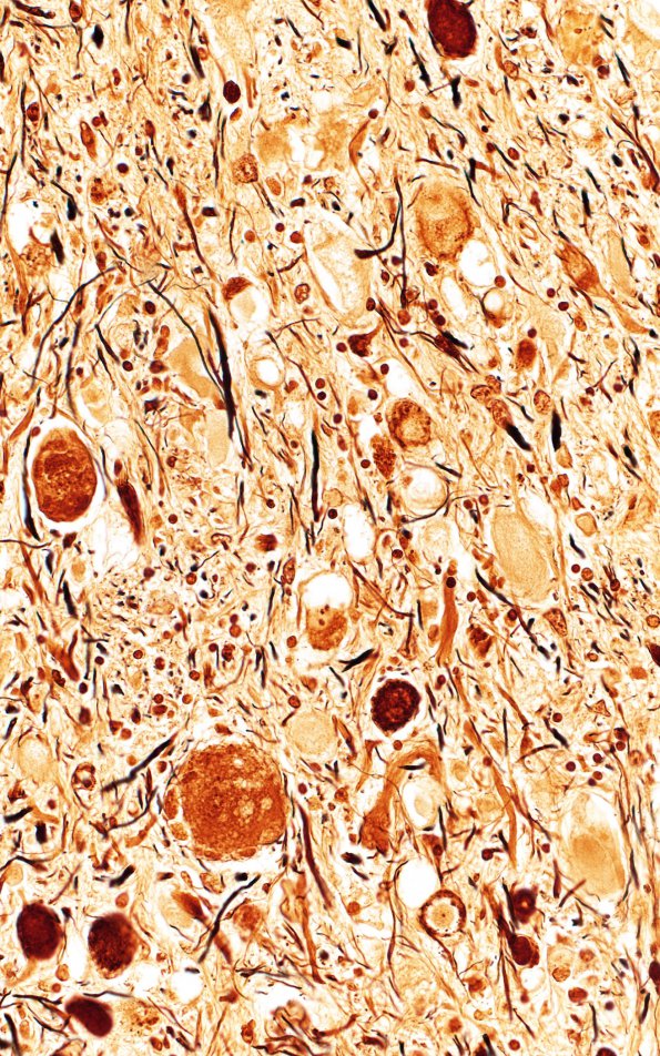 1F8 INAD (Seitelberger Dz, Case 1) Gracile F Biels 40X