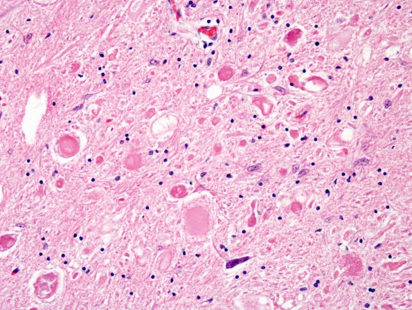 1G3 INAD (Seitelberger Dz, Case 1) H&E dorsal horn 1