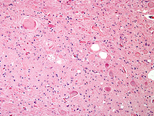 1G4 INAD (Seitelberger Dz, Case 1) H&E dorsal horn 2