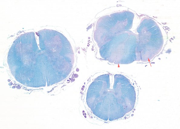 1G6 INAD (Seitelberger Dz, Case 1) Dorsal Horn Lumbar Cord  LFB-PAS 2 (2) copy