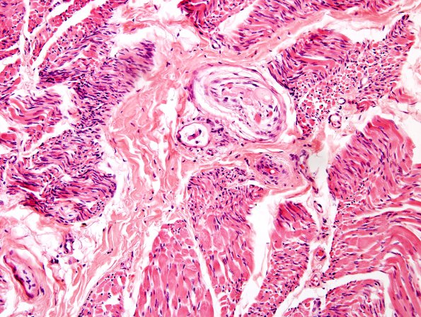 1H2 INAD (Seitelberger Dz, Case 1) H&E muscle nerves 3