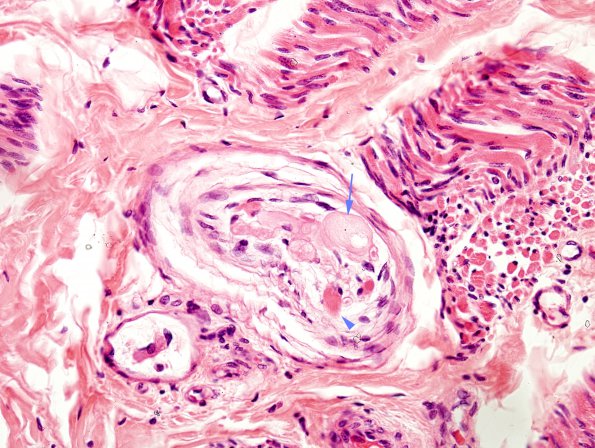 1H3 INAD (Seitelberger Dz, Case 1) H&E muscle nerves 2 copy