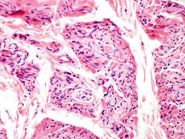 1H4 INAD (Seitelberger Dz, Case 1) H&E muscle nerves 4 copy