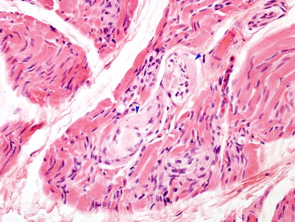 1H5 INAD (Seitelberger Dz, Case 1) H&E muscle nerves 5a