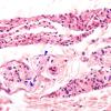 1H6 INAD (Seitelberger Dz, Case 1) H&E muscle nerves 6a