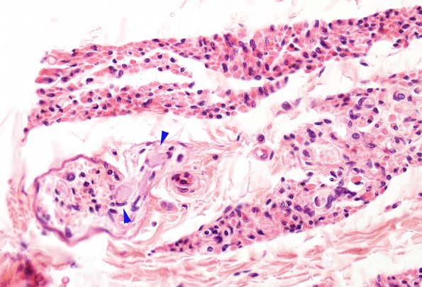 1H6 INAD (Seitelberger Dz, Case 1) H&E muscle nerves 6a