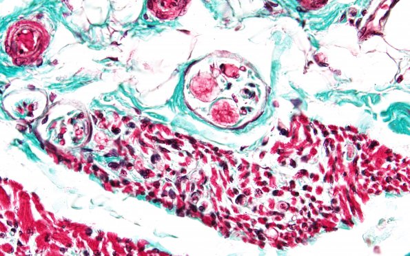 1H8 INAD (Seitelberger Dz, Case 1) R Tri 60X 1