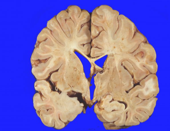 2A3 INAD (Seitelberger Dz, Case 2) 1