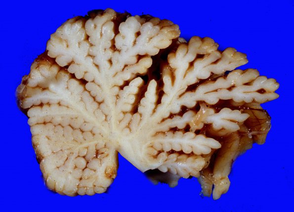 2A5 INAD (Seitelberger Dz, Case 2) 3