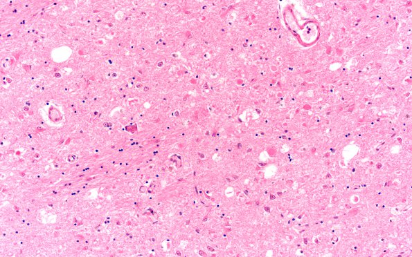 2C1 INAD (Seitelberger Dz, Case 2) I Basal ganglia anterior H&E 20X 2