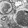 2C5 INAD (Seitelberger Dz, Case 2) EM2