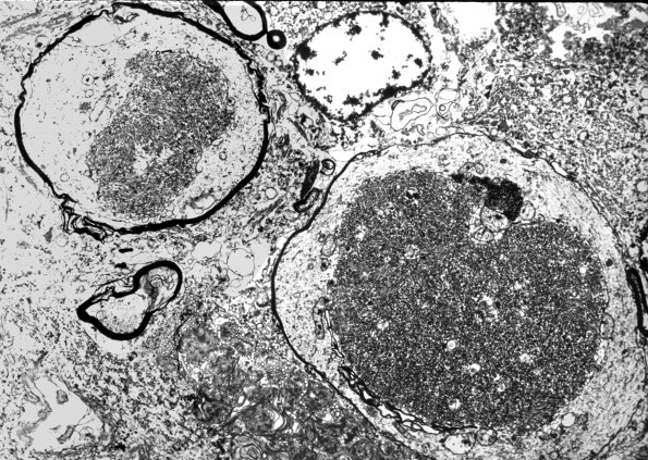 2C5 INAD (Seitelberger Dz, Case 2) EM2