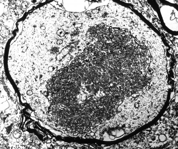 2C6 INAD (Seitelberger Dz, Case 2) EM1