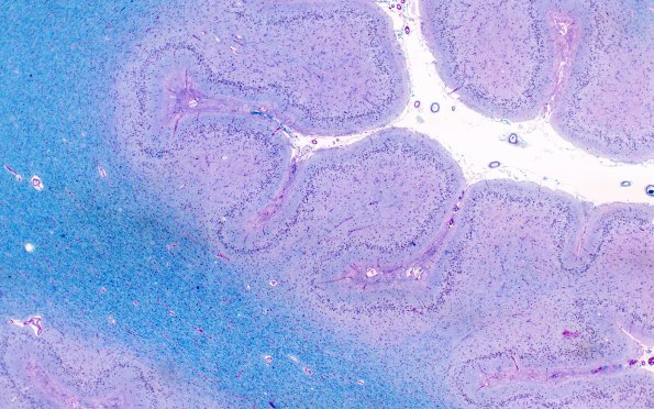 2D2 INAD (Seitelberger Dz, Case 2) G Cbell LFB-PAS 4X