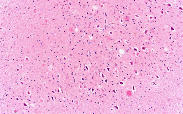 2D3 INAD (Seitelberger Dz, Case 2) G Cbell H&E dentate 20X