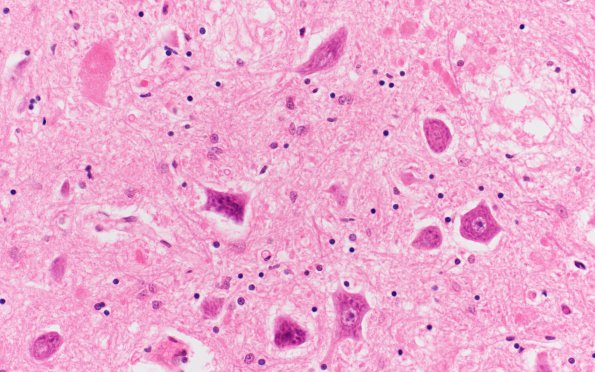 2E4 INAD (Seitelberger Dz, Case 2) D III nerve Midbrain