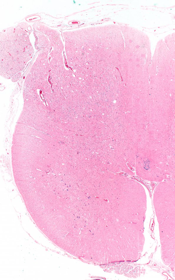 2F1 INAD (Seitelberger Dz, Case 2) L Sacral cord 2X