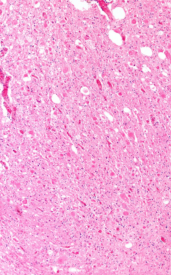 2F6 INAD (Seitelberger Dz, Case 2) L Sacral cord  Dorsal horn 10X