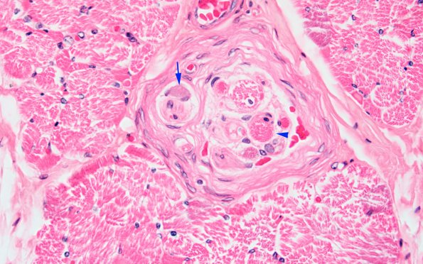 2I1 INAD (Seitelberger Dz, Case 2) M Muscle 40X copy