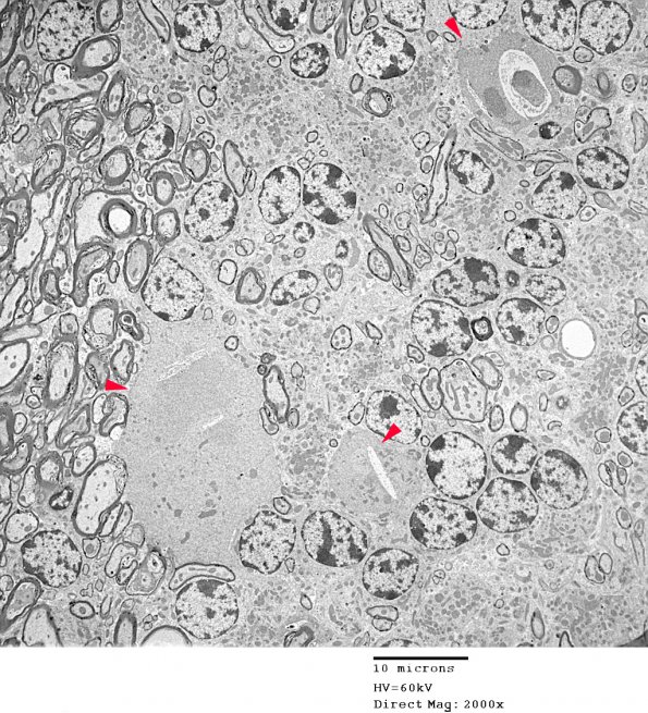 3D3 iPLA2beta KO Cerebellum Dystrophy (06-212H) EM 1 copy - Copy