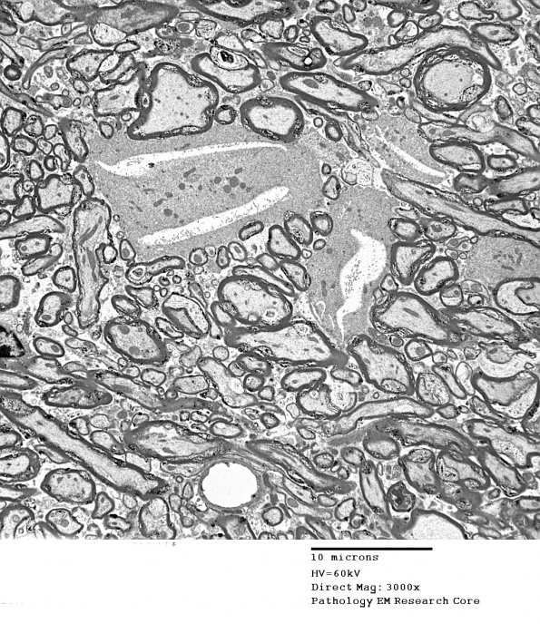 3D4 iPLA2beta KO Cerebellum Dystrophy (06-212H) EM 10 - Copy