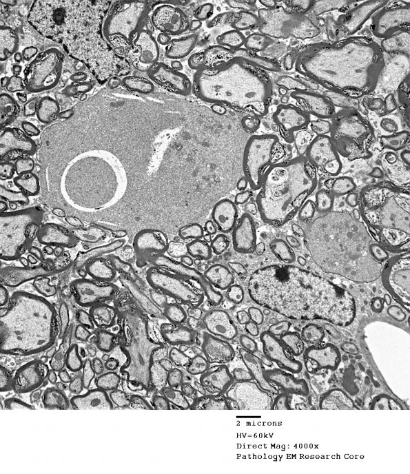 3D6 iPLA2beta KO Cerebellum Dystrophy (06-212H) EM 12 - Copy