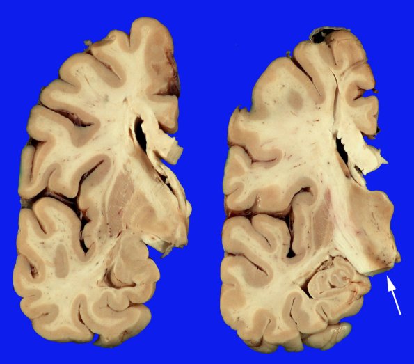 10 Parkinson Dz (Case 10) _2 copy