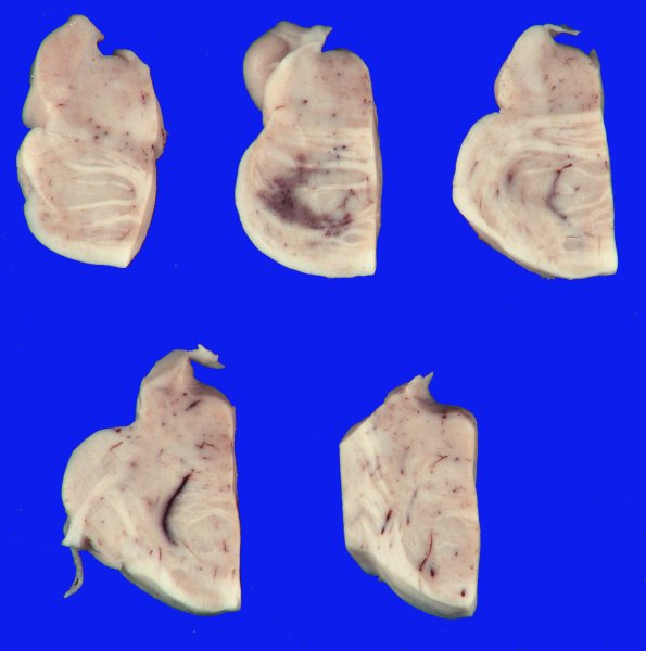 14 Parkinson Dz (Case 14) _2