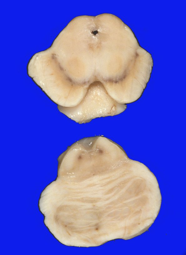 16 Parkinson's Dz (Case 16) Gross