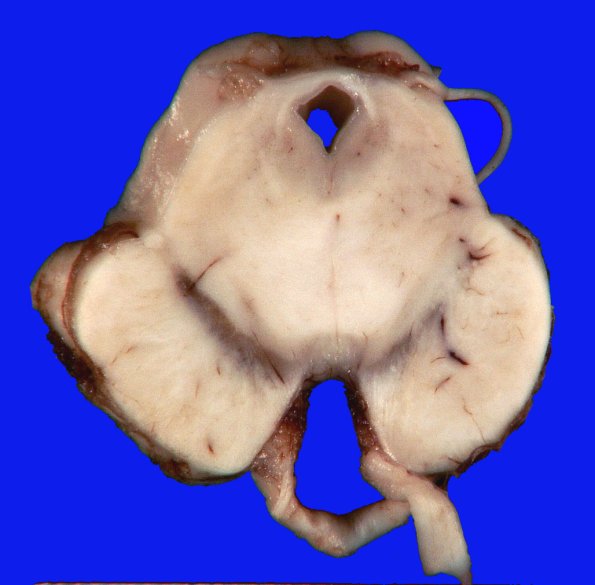 1A1 Brainstem, normal (Case 1) Gross _2