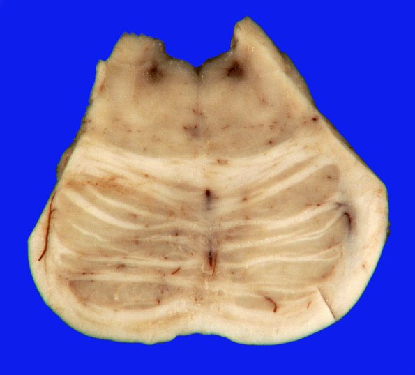 1A2 Brainstem, normal (Case 1) Gross _3