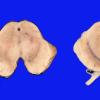 2 Parkinson's Dz (Case 2)  PD and NL 1