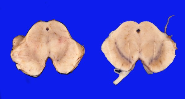 2 Parkinson's Dz (Case 2)  PD and NL 1