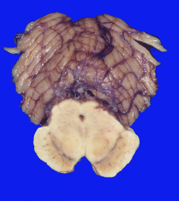 22 PD, subclinical (Case 22)