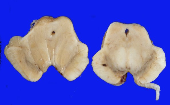 4 Parkinson's Dz (Case 4)  PD and NL 1