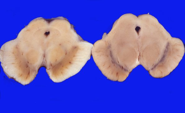 5 Parkinson's Dz (Case 5 WUMS Case) 4