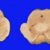 9 Parkinson Dz (Case 9) 2