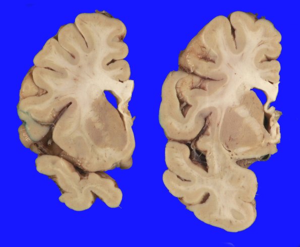 10A2 DLBD (Case 10) _3